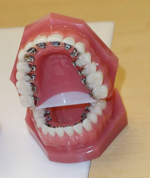 Lingual Braces